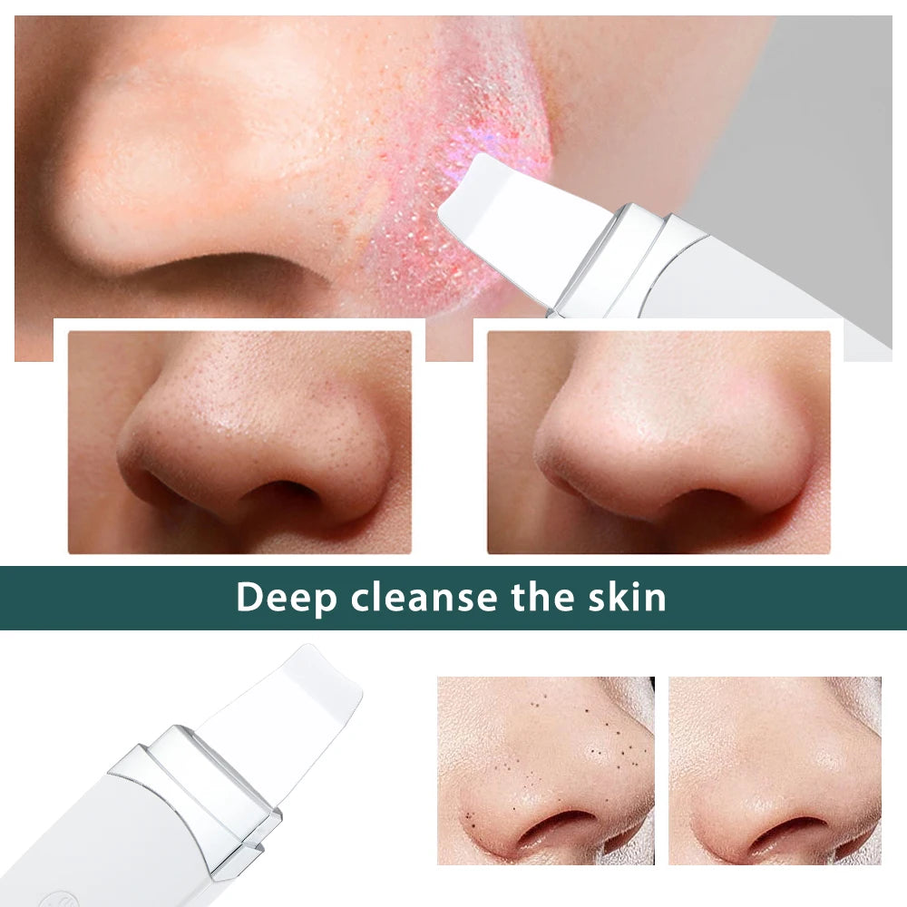 Ultrasonic Skin Scrubber Peeling Blackhead Remover Face Lifting Deep Face Cleaning Ion Ance Pore Cleaner Facial Shovel Cleaner